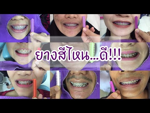 ยางดัดฟันสีไหนสวย - คำถามที่ใครหลายคนกำลังสงสัยปัจจุบัน! - Kcn Việt Phát